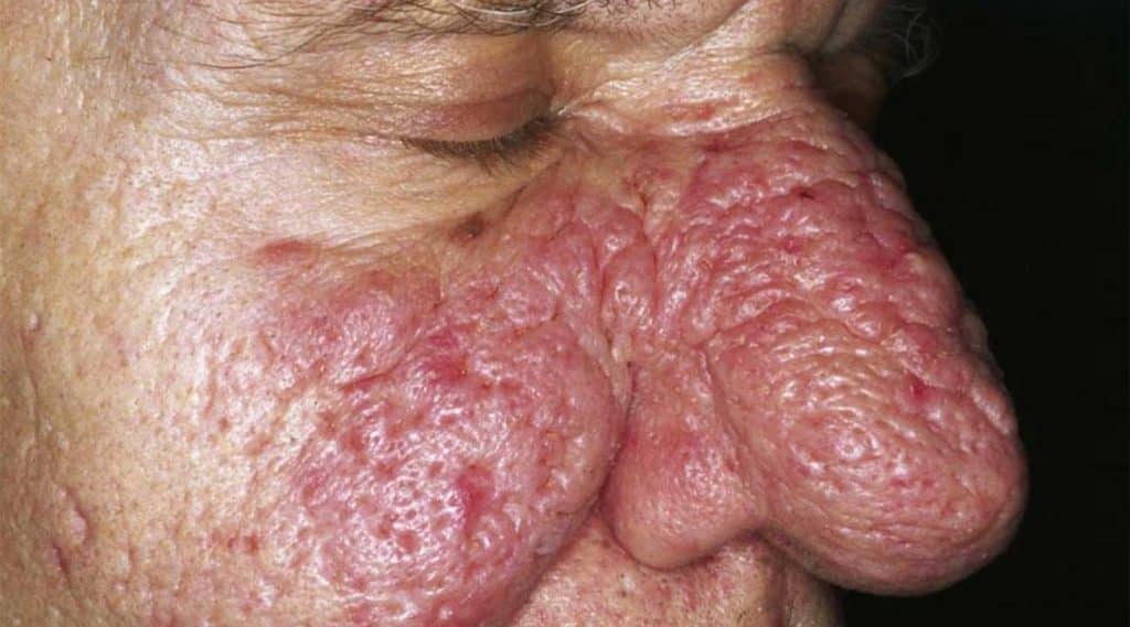 Rhinophyma: What Is Alcoholic Nose? Elderly man with a red, irritated, bulbous nose