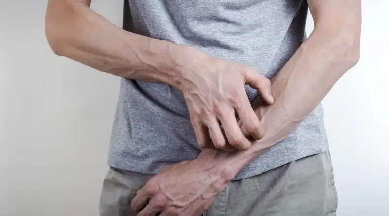 Meth Mites, man scratching his arms