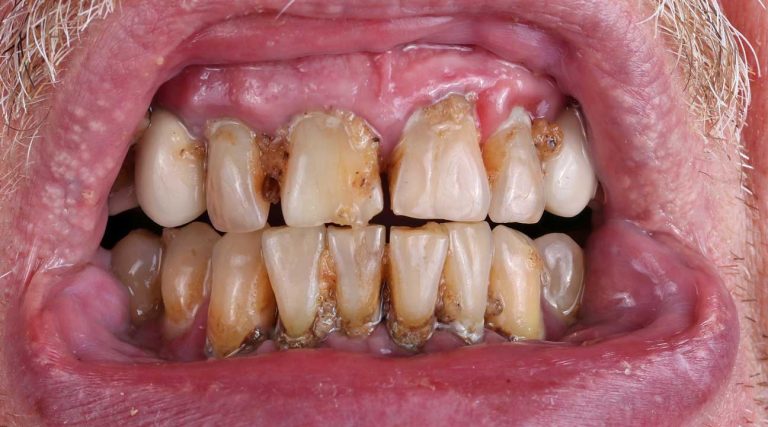 Meth mouth what does meth mouth look like?