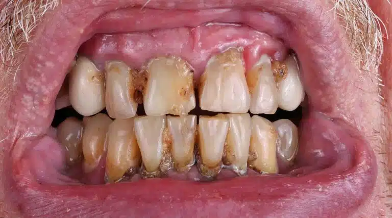 Meth mouth what does meth mouth look like?