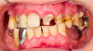 Man with Meth Mouth, broken, chipped, black, brown, missing teeth