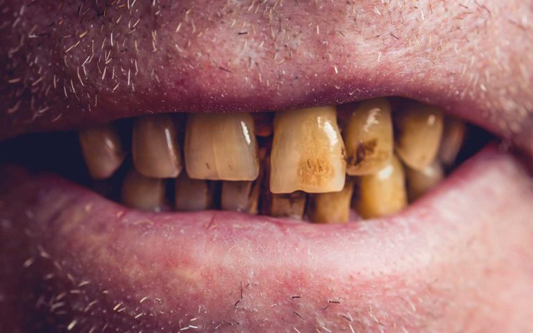 Crack & Tooth Decay | Effects Of Crack On Oral Health