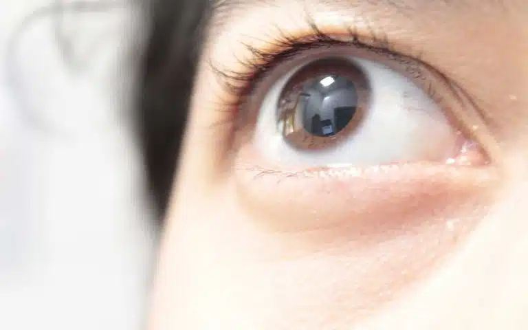 Opiates, Eyes, & Pupils | What Do Opioid Eyes Look Like?