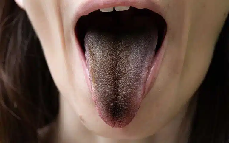 Black hair on tongue sale