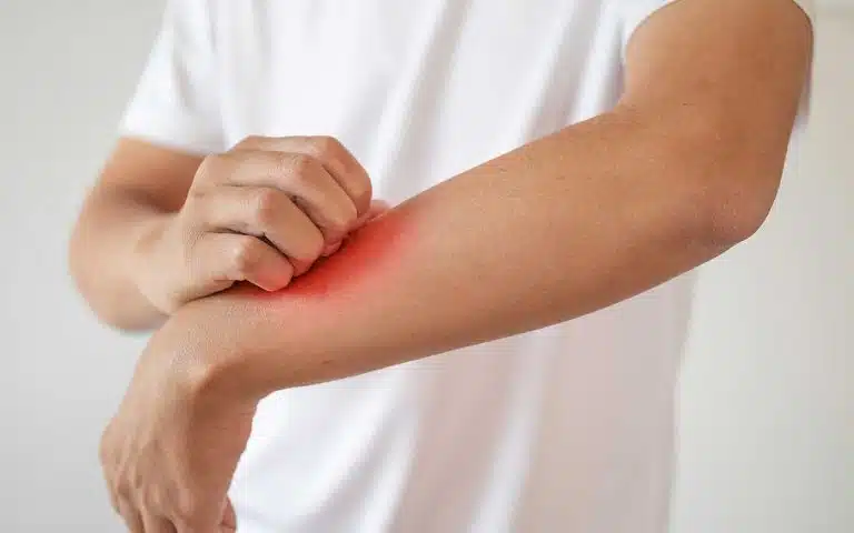 Why Does Heroin Make You Itch?