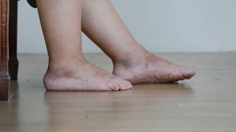 Can Alcoholism Cause Swollen Feet?