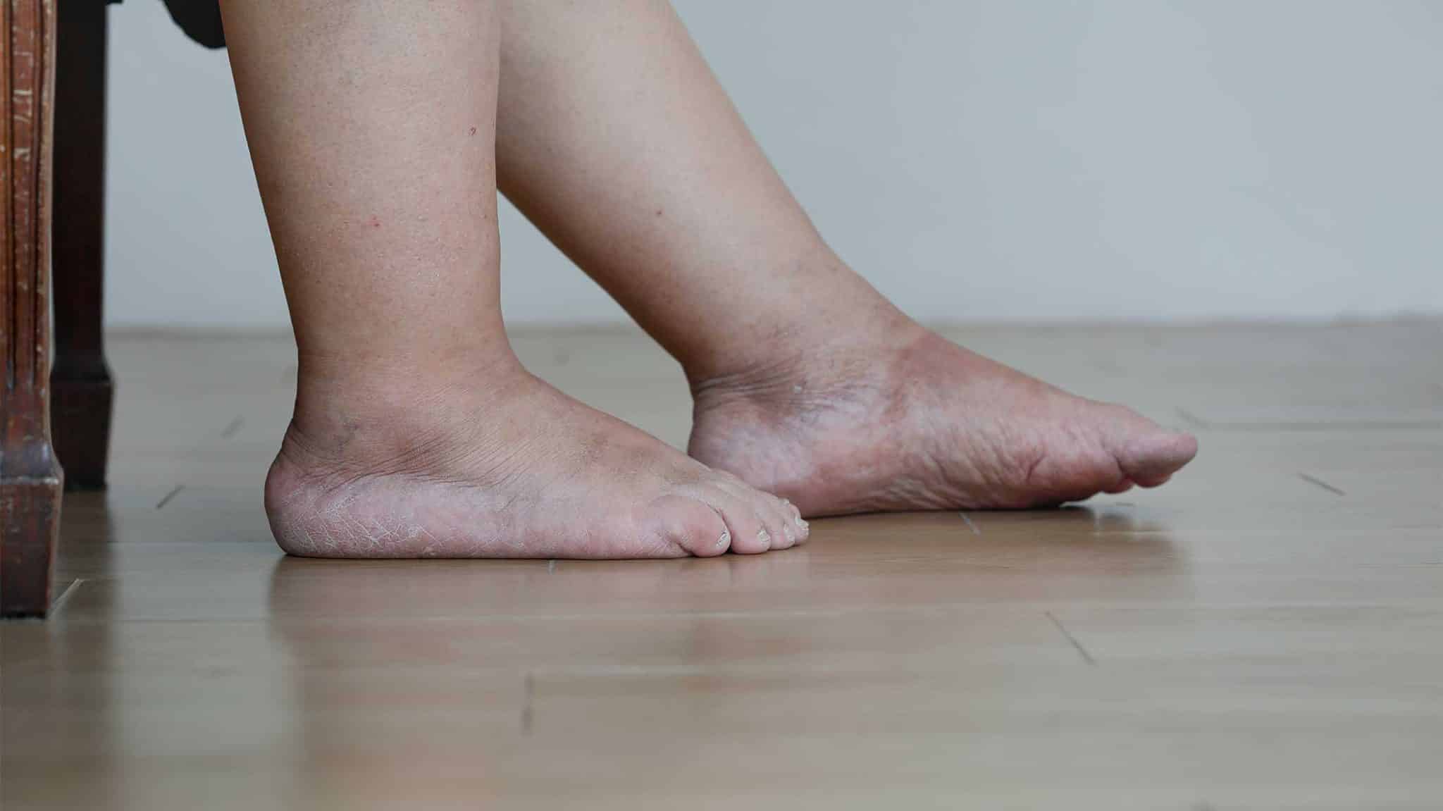 Does Alcohol Cause Swelling in Feet?
