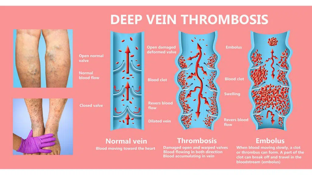 Deep Vein Thrombosis DVT description and symptoms