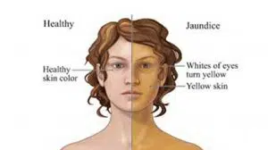Yellow eyes and skin. Major signs of Jaundice or liver disease.