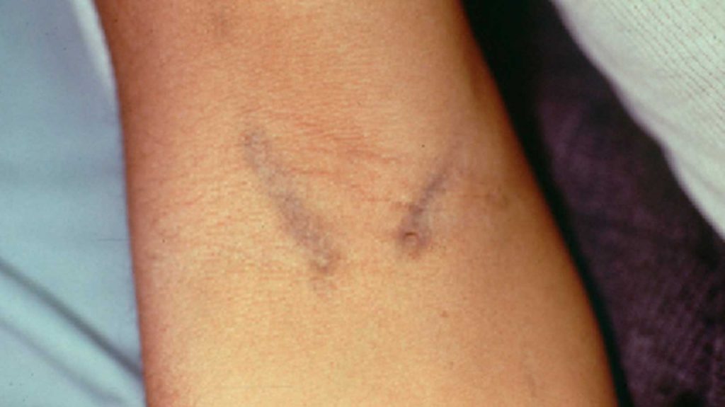 Vein Damage From IV Drug Use ARK Behavioral Health